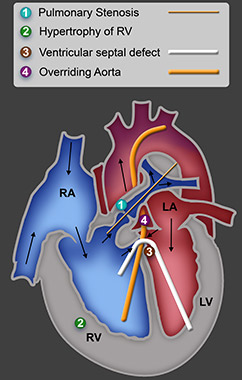 Tetralogy of Fallot diagram